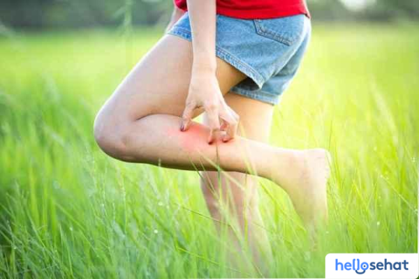 Obati Sengatan Tawon Cepat? Pertolongan Pertama & Obat Terbaik